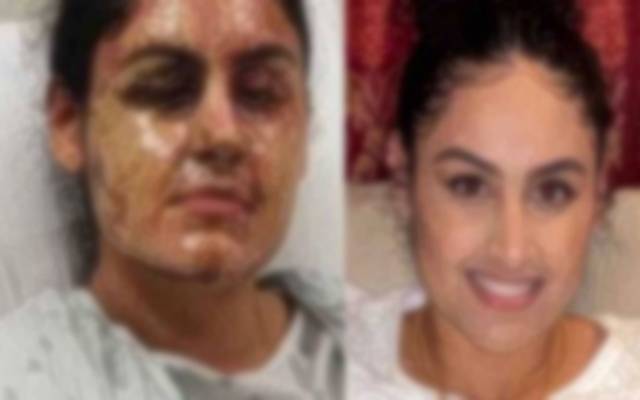 girl file photo and after acid attack