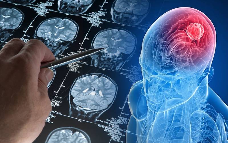 پاکستان سمیت دنیا بھر میں آج برین ٹیومر (Brain Tumor ) کا عالمی دن منایا جارہا ہے 